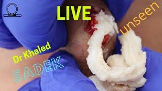 Multiple Cyst Removal Part 2. Dr Khaled Sadek. LipomaCyst.com