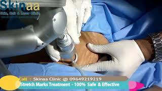 Pregnancy Stretch Marks Treatment by Laser in Jaipur, India – Skinaa Clinic