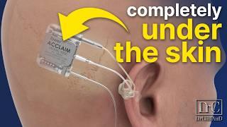 100% INVISIBLE Cochlear Implant | Acclaim by Envoy Medical