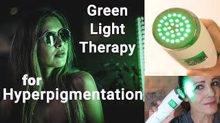 Green Light Therapy for Hyperpigmentation