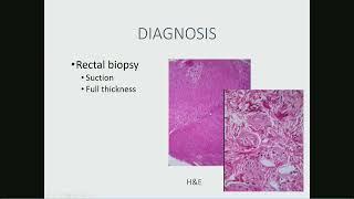 Controversies in the Management of Hirschsprung Disease - Tapper Surgery Lecture