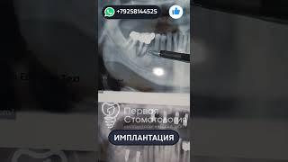 Имплантация зубов пациенту. Подвижный мост №2