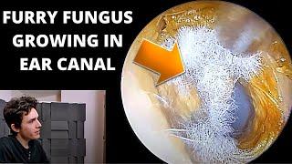 Mystery Furry Fungus Growing in Ear