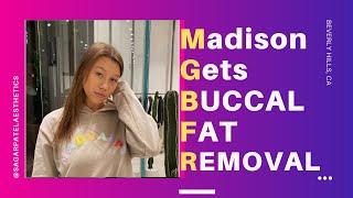 Patient Experience: How to Lose Face Fat! (Buccal Fat Removal)