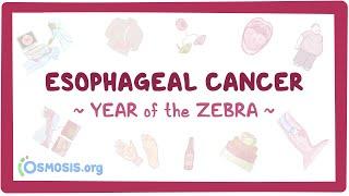 Esophageal Cancer (Year of the Zebra)