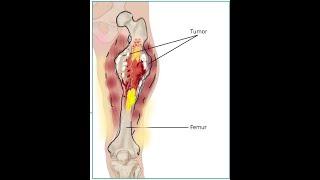 Ewing’s  Sarcoma