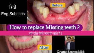 How to replace missing teeth ? What is dental bridge ? नए दाँत कैसे लगाए जाते है ?