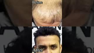 Hair Transplant Amazing Results By Anagen Clinic // Mumbai // #hairtransplant #hairtransplantmumbai