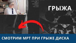 Разбор МРТ пациента с грыжей диска. Почему выбрана операция?