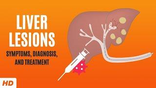 Liver Lesions: Symptoms, Diagnosis and Treatment