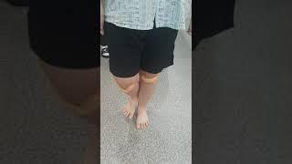 무릎관절 전방십자인대 재건술후 2주차에 실시하는 재활운동. 한발로 중심잡기