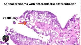 What do you know about hepatoid carcinoma