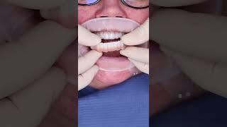 Dental implant’s All on 4 in Prague #shorts #dentist #dental #implant #veneers #short