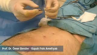 Kapalı Fıtık Ameliyatı - Prof. Dr. Ömer Bender