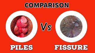 Comparison - PILES Vs FISSURE - ( English Language )