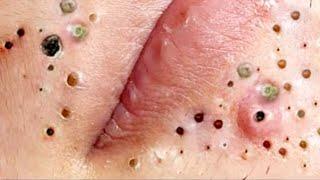 Top#4 Big Cystic Acne Blackheads Extraction Whiteheads & Milia,Blackheads Removal Pimples Popping