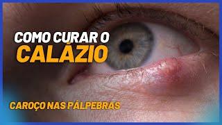 Calázio | O que causa? Como tratar ou curar?