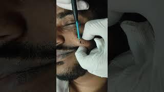 Mole Removal cost #shortvideo #shots