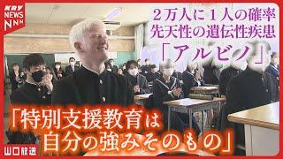 アルビノの高校生が語る「障害と夢」への挑戦！周りと一緒がいい、それが自分の一番強い願望