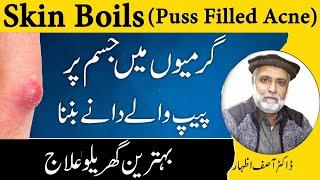 Puss Filled Acne Causes,Symptoms And Treatment In Urdu