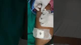 Lipomas Surgery dressing removal after 3 days #dezireclinic