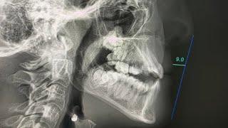  teeth extracted for orthodontic treatment disaster, aligning the teeth destroying the body