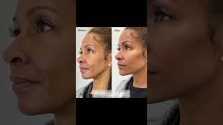 Instant, Non-Surgical Facial Contouring