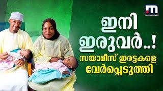 19 മണിക്കൂർ നീണ്ട ശസ്ത്രക്രിയ; ഒമാനിൽ സയാമീസ് ഇരട്ടക്കുട്ടികളെ വേർപ്പെടുത്തി; രാജ്യത്ത് ആദ്യം | Oman