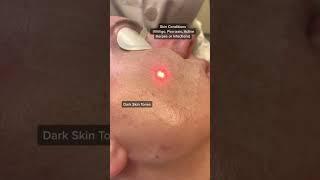 Who should NOT have Ablative Laser Resurfacing #shorts #shortvideo