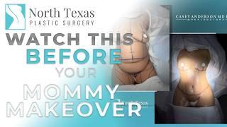 Watch This BEFORE Your Mommy Makeover | How to Prepare