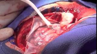 Video Atlas of Neurosurgery 1e: Awake Craniotomy & Speech Mapping for Gliomas