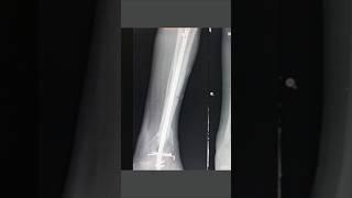 Xray Tibia Ap lateral view #anatomy #xraytechnician #humananatomy #radiologycareer #baby #humanbody