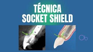 Técnica de Socket Shield ️