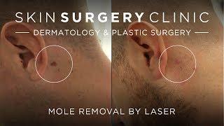 Laser Mole Removal | David's Testimonial