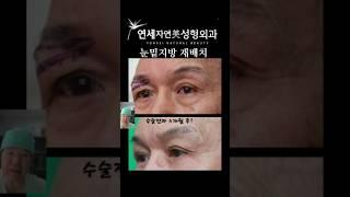 눈밑 지방재배치 4개월 후 결과는?#연세자연미성형외과 #lowerblepharoplasty#하안검성형#눈밑지방 #신촌성형외과 #홍대성형외과
