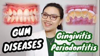 GUM DISEASE: Gingivitis and Periodontitis  Namamagang gilagid, masama ba? | Dr. Bianca Beley