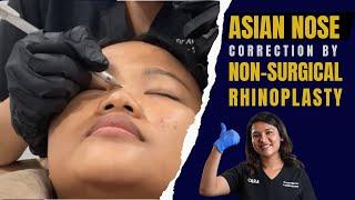 Nonsurgical Rhinoplasty in India /Mumbai | 15 minutes Nosejob in Mumbai (Live Procedure)