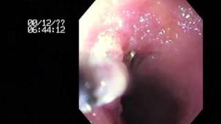 Endoscopy of a Canine Duodenum - Colorado State University Veterinary Teaching Hospital