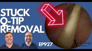 STUCK Q-TIP REMOVAL FROM EAR - EP927