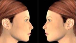 Closed Rhinoplasty surgery (nosejob)