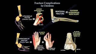 Common Pediatric Fracture Complications.