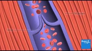 How deep vein thrombosis (DVT) forms