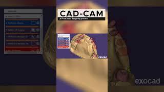 Dental Crowns in Making with CAD-CAM Exocad Software