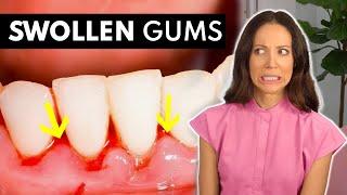 What SWOLLEN GUMS Are Telling You & What To Do About It!