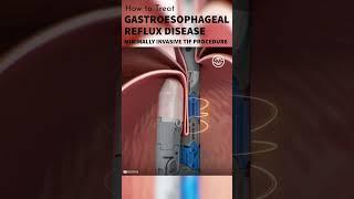 Gastroesophageal Reflux Disease (GERD) Treatment #shorts #tutorial #medical #animation #surgmedia