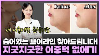 숨어있는 브이라인 찾아드립니다! 지긋지긋한 이중턱 없애는 시술 공개(전후사진有) 부천인모드, 부천브이올렛, 신중동피부과