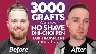 Hair Transplant in Turkey | No Shave DHI with CHOI PEN | 3000 Grafts Before and After