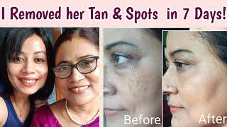 How I Transformed my Mother's Skin| Tan removal home remedies| dark spots on face removal