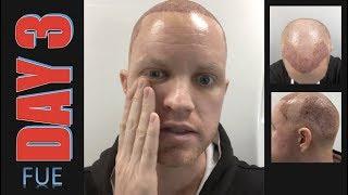 DAY 3 After FUE Hair Transplant