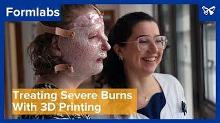 Treating Children’s Severe Burns: Face Masks Produced With 3D Printing